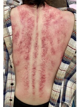 スキンスキン(SKINSKIN)の写真/【台湾式カッサ】で体の不調を取り除く！！赤みを出さない施術も可能◎お気軽にご相談くださいませ♪