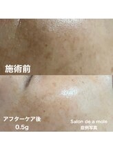 サロンドアモール(Salon de a mole)/ハーバルシー症例写真/シミ