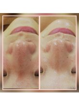 エクラ(eclat)/水素ピーリング　ハイドラ