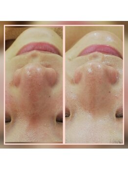 エクラ(eclat)/水素ピーリング　ハイドラ