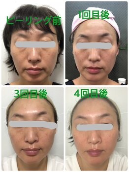 ナナラ(nanala)/OHLバーブピーリング