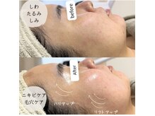 肌育ボンバーフェイシャル★エイジングケア、ニキビケア
