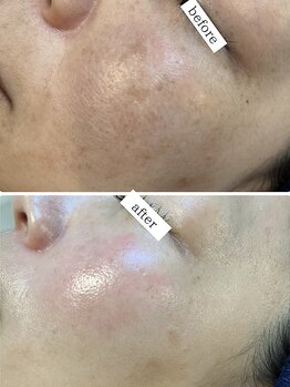 イロドリ(irodori)/本気の肌改善/104日間プログラム