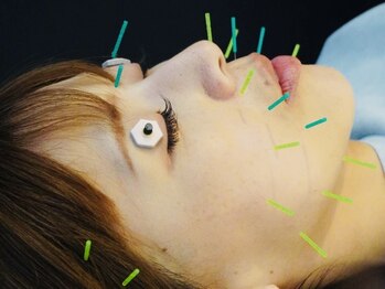 ビゴー鍼灸院 円山院(bigo鍼灸院)/ニキビ顔はもうヤダ！肌質改善★