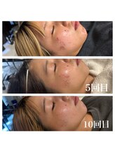 ルビー 池袋店(Ruby)/最新の針入りハーブピーリング