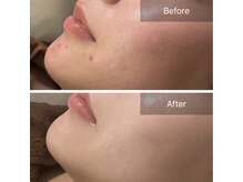 素肌研究所BSラボの雰囲気（気になる箇所に徹底アプローチ◎[ハーブピーリング]）