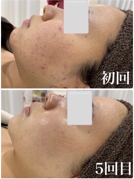 リュミエール デスポワール(Lumiere d'espoir)/ハーブピーリング