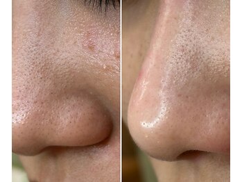 サイ(Sai)/もう、元の肌に戻りたくない！