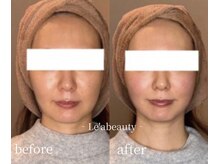 レアビューティー(Le'a beauty)の雰囲気（当店大人気サーマトリックスでコケずにたるみ改善　ハリ艶リフト）