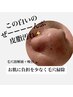 毛穴汚れゼロへ【毛穴黒ずみ/詰まり】毛穴洗浄×高濃度ビタミン×パック