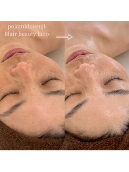 ポーラ Blair店(POLA)/日焼け後の鎮静