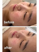 ランソ ビューティー 成田(RUNSO Beauty)/ハイドラ毛穴洗浄×ポレーション