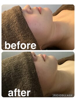 ギンザアール(GINZA R.)/理想の小顔に◎