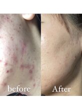 アルマサロン 菊陽(Almasalon)/【HAAB REPRO】ハーブリプロ