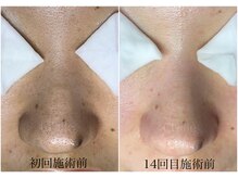 シエール 調布(Ci'aile)/本気の毛穴肌質改善