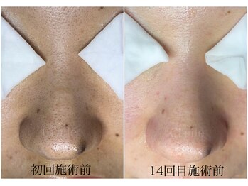 シエール 調布(Ci'aile)/本気の毛穴肌質改善