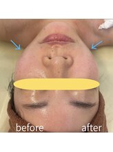 癒しの郷 池袋店/ハイパー小顔+小顔コルギ