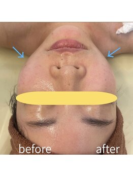 癒しの郷 池袋店/ハイパー小顔+小顔コルギ