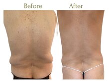 セレブリボーン 大阪ボーテ/浮き輪/内臓脂肪／男性