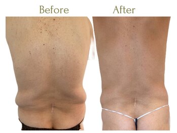 セレブリボーン 大阪ボーテ/浮き輪/内臓脂肪/男性