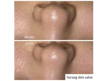 サラン スキンサロン(Sarang skin salon)の雰囲気（1回の施術でも変化を実感♪）
