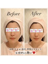 アンジェリカ(Angelica)/小顔矯正と筋膜リリースで造顔