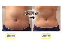 ヴィータサナ(Vita-Sana)/◆お腹引締め◆３か月後