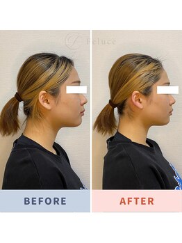 サロン ド フェルーチェ(salon de Feluce)/小顔矯正