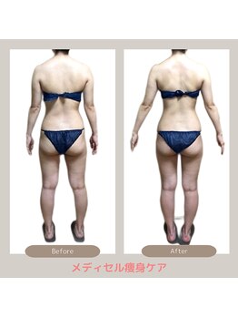 トレゾアスィス(Tresor sis)/痩身/ダイエット/筋膜リリース