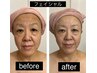 オイルリンパ40分＋リフトアップフェイシャル80分(120分)