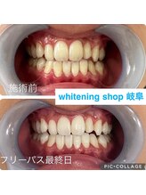 ホワイトニングショップ 岐阜駅前/#岐阜ホワイトニング#岐阜エステ