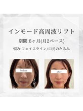 メディカルエステ 恵比寿店/＊インモードお顔 症例＊