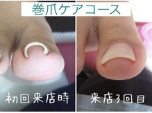 エール バイ クレアチュールドゥエ(ailes by creaturedoue)/まき爪・陥入爪　ご相談ください