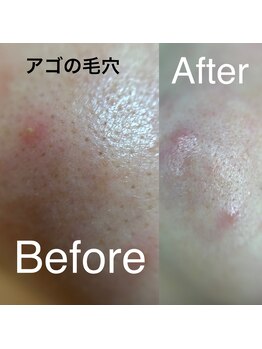 ルミエール(LUMIE’RE)/毛穴洗浄ハイドロスプラッシュ