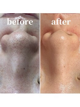 スピカ(Spica)/ここまでキレイになりました♪