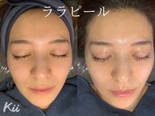 キー(kii)/ララピールで水光肌