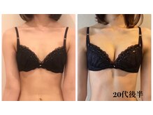 リール 新宿店(RIRE)/20代後半 バストアップ症例