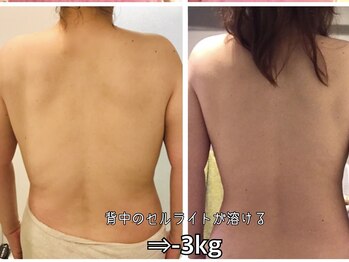 ヨサパーク ハット(YOSA PARK HAT)/背中のセル脂肪も