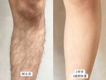 セルフメイド 東大阪店(SELFMADE)/足脱毛♪BeforeAfter