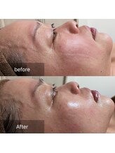 ココカラ(COCOKARA)/インディバ 　小顔リフト