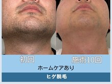 アロマ(AROMA)/メンズ脱毛/ヒゲ脱毛/7回後