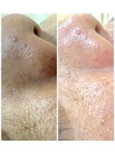 エミタス整骨院/毛穴洗浄は男性にも大人気！