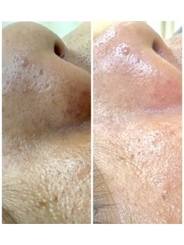 エミタス整骨院/毛穴洗浄は男性にも大人気！