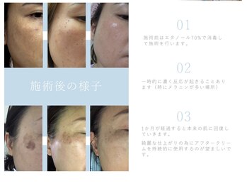 ビューティサロン エフ(beautysalon F)/ホワイトラボ経過