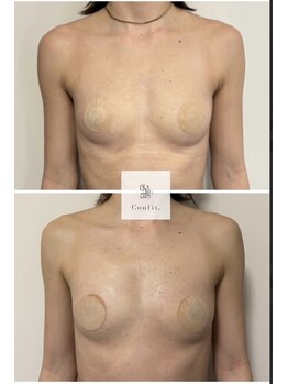 エルミナ.(elmina.)/クーパー靭帯修復！美デコルテ♪