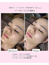 リノア 堀江(Linoa)/毛穴洗浄＆ハーブピーリング