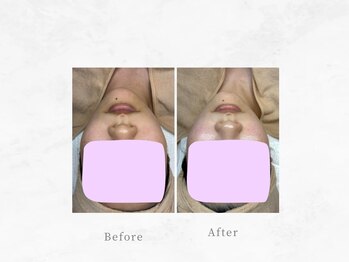 ジーンバイピエル 中野店(gene by PIEL)の写真/【当店人気No.1新ララピール】毛穴も肌質も変わる！結果重視の施術でお肌悩みを解決に導きます。【中野】