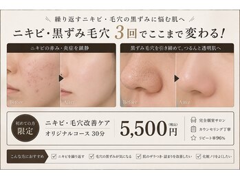 ビジュー(Bijou)の写真/【初回限定｜ニキビ・毛穴黒ずみ改善コース 5,500（税込）】