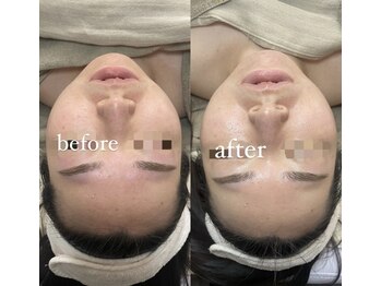 サーデ(saade)/眉毛ワックス後のお肌にも♪