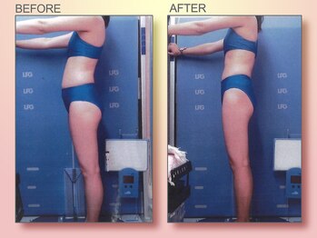 ジュリア オージェ 京橋店/ビフォーアフター(脂肪燃焼)